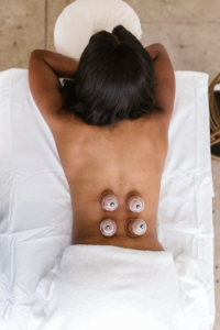 top view of a woman lying upside down on a massage table getting cupping therapy